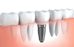 Home dental implants.webp